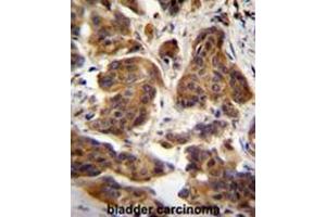 C4orf21 Antibody (N-term) immunohistochemistry analysis in formalin fixed and paraffin embedded human bladder carcinoma followed by peroxidase conjugation of the secondary antibody and DAB staining. (ZGRF1 anticorps  (N-Term))