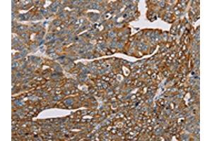 The image on the left is immunohistochemistry of paraffin-embedded Human cervical cancer tissue using ABIN7130290(MTFP1 Antibody) at dilution 1/30, on the right is treated with fusion protein. (Mtfp1 anticorps)