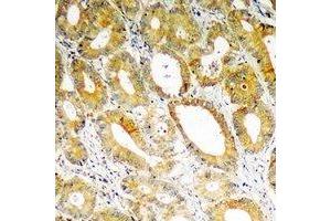 Immunohistochemical analysis of PDK4 staining in human colon cancer formalin fixed paraffin embedded tissue section. (PDK4 anticorps)
