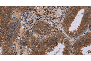 Immunohistochemistry of paraffin-embedded Human colon cancer tissue using NPTX1 Polyclonal Antibody at dilution 1:50 (NPX1 anticorps)