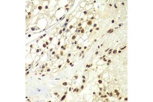 Immunohistochemistry of paraffin-embedded human kidney cancer using RPA2 Antibody. (RPA2 anticorps  (AA 80-270))