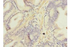 Immunohistochemistry of paraffin-embedded human prostate cancer using ABIN7160892 at dilution of 1:100