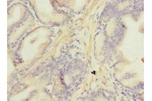 Immunohistochemistry of paraffin-embedded human prostate cancer using ABIN7160892 at dilution of 1:100 (NDUFA13 anticorps  (AA 52-144))
