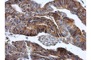 IHC-P Image HPRT antibody detects HPRT protein at cytoplasm in human colon cancer by immunohistochemical analysis. (HPRT1 anticorps)