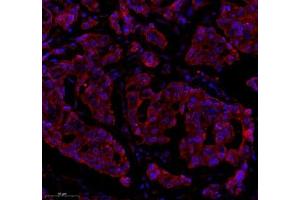 Immunofluorescence of paraffin embedded human breast cancer using Epl4 (ABIN7073843) at dilution of 1:2000 (300x lens) (EFNA4 anticorps)