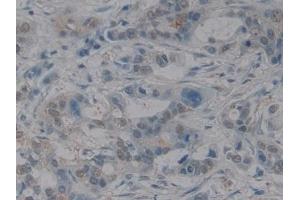 Detection of HMGB1 in Human Pancreatic cancer Tissue using Polyclonal Antibody to High Mobility Group Protein 1 (HMGB1) (HMGB1 anticorps  (AA 9-163))