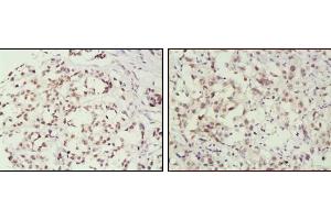 Immunohistochemical analysis of paraffin-embedded human breast cancer (left) and lung cancer (right) tissues, showing nuclear localization using MSH2 mouse mAb with DAB staining. (MSH2 anticorps)