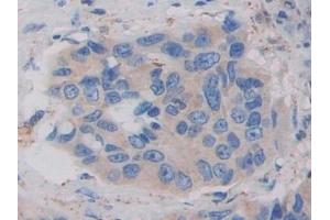 Detection of DDX58 in Human Breast cancer Tissue using Polyclonal Antibody to Probable ATP-dependent RNA Helicase DDX58 (DDX58) (DDX58 anticorps  (AA 550-776))