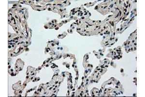 Immunohistochemical staining of paraffin-embedded Adenocarcinoma of breast tissue using anti-MKI67 mouse monoclonal antibody. (Ki-67 anticorps  (AA 1-250))