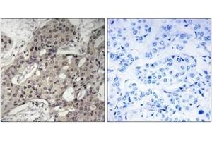 Immunohistochemistry analysis of paraffin-embedded human breast carcinoma tissue, using RPL3 Antibody.