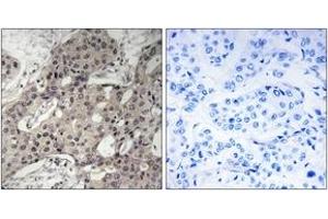 Immunohistochemistry analysis of paraffin-embedded human breast carcinoma tissue, using RPL3 Antibody. (RPL3 anticorps  (AA 211-260))