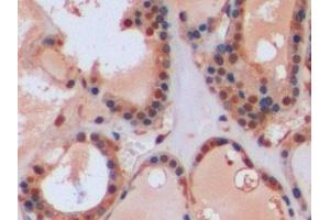 Detection of GSTp in Human Thyroid Tissue using Polyclonal Antibody to Glutathione S Transferase Pi (GSTp)