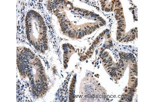 Immunohistochemistry of Human colon cancer using KLK7 Polyclonal Antibody at dilution of 1:10 (Kallikrein 7 anticorps)