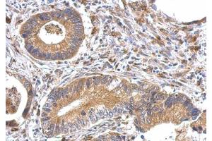 IHC-P Image OFD1 antibody detects OFD1 protein at cytosol on human gastric cancer by immunohistochemical analysis. (OFD1 anticorps  (Center))