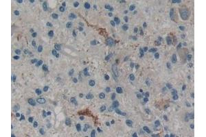 Detection of PLA2G4 in Human Glioma Tissue using Polyclonal Antibody to Cytosolic Phospholipase A2 (PLA2G4)