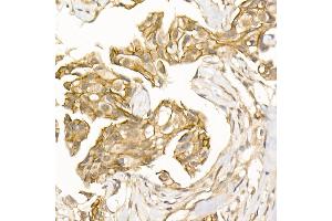 Immunohistochemistry of paraffin-embedded Human breast cancer using β-Catenin antibody (ABIN7266138) at dilution of 1:100 (40x lens).