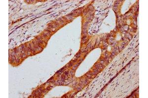 IHC image of ABIN7150742 diluted at 1:400 and staining in paraffin-embedded human colon cancer performed on a Leica BondTM system.