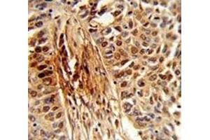 IHC analysis of FFPE human lung carcinoma stained with PIN1 antibody