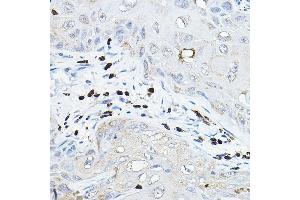 Immunohistochemistry of paraffin-embedded human esophageal cancer using NOX/p67phox Rabbit pAb (ABIN3021640, ABIN3021641, ABIN3021642, ABIN1513243 and ABIN6215468) at dilution of 1:100 (40x lens). (NCF2 anticorps  (AA 227-526))