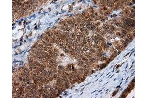 Immunohistochemical staining of paraffin-embedded Adenocarcinoma of colon tissue using anti-MTRF1L mouse monoclonal antibody. (MTRF1L anticorps)