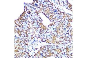 Immunohistochemistry of paraffin-embedded human colon carcinoma using HSP60/HSPD1 Rabbit mAb (ABIN1680746, ABIN3015220, ABIN3015221 and ABIN7101321) at dilution of 1:100 (40x lens). (HSPD1 anticorps)