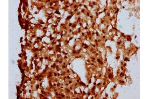 IHC image of ABIN7160108 diluted at 1:500 and staining in paraffin-embedded human melanoma performed on a Leica BondTM system. (MKL2 anticorps  (AA 164-313))