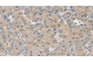 Immunohistochemistry of paraffin-embedded Human liver cancer using SMOC2 Polyclonal Antibody at dilution of 1:30
