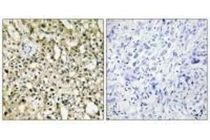 Immunohistochemistry analysis of paraffin-embedded human liver carcinoma tissue using Myc antibody.