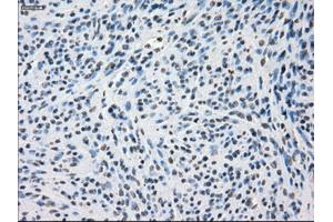Immunohistochemical staining of paraffin-embedded Adenocarcinoma of colon tissue using anti-SSX2mouse monoclonal antibody. (SSX2 anticorps)
