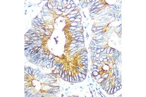 Immunohistochemistry of paraffin-embedded human colon carcinoma using Aquaporin-1 (Aquaporin-1 ) Rabbit mAb (ABIN1682901, ABIN3018679, ABIN3018680 and ABIN7101646) at dilution of 1:100 (40x lens). (Aquaporin 1 anticorps)