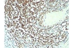 Formalin-fixed, paraffin-embedded human bladder carcinoma stained with Nucleolin antibody (364-5 + NCL/902). (Nucleolin anticorps)