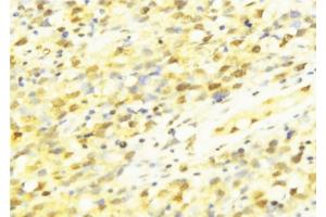 ABIN6273465 at 1/100 staining Human breast cancer tissue by IHC-P.