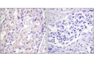 Immunohistochemistry analysis of paraffin-embedded human breast carcinoma, using p90 RSK (Phospho-Thr359+Ser363) Antibody. (RPS6KA3 anticorps  (pThr359))