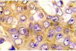 Immunohistochemistry (IHC) analyzes of BAD antibody in paraffin-embedded human breast carcinoma tissue. (BAD anticorps)