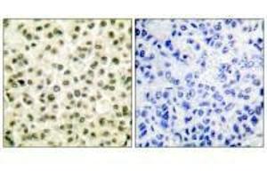 Immunohistochemical analysis of paraffin-embedded human breast carcinoma tissue using Ku70/80 antibody. (XRCC6 anticorps)
