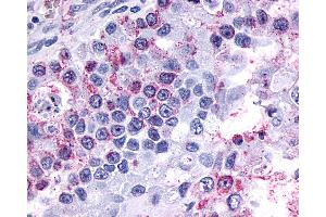 Anti-GPR3 antibody IHC of human Ovary, Carcinoma. (GPR3 anticorps  (Extracellular Domain))