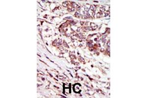 Formalin-fixed and paraffin-embedded human hepatocellular carcinoma tissue reacted with CAMK1G polyclonal antibody  , which was peroxidase-conjugated to the secondary antibody, followed by AEC staining. (CAMK1G anticorps  (C-Term))