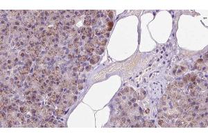 ABIN6273238 at 1/100 staining Human pancreas cancer tissue by IHC-P. (ETFA anticorps  (Internal Region))