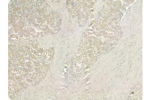 ABIN6258492 and ABIN6274927 at 1/100 staining human prostate carcinoma by IHC-P. (BCAS4 anticorps  (Internal Region))