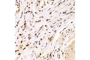 Immunohistochemistry of paraffin-embedded Human gastric cancer using PPP1R8 antibody at dilution of 1:100 (x400 lens). (PPP1R8 anticorps)