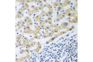 Immunohistochemistry of paraffin-embedded human liver cancer using SHBG antibody (ABIN5975291) at dilution of 1/100 (40x lens).