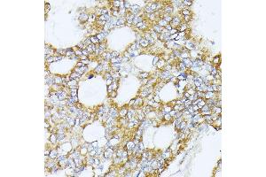 Immunohistochemistry of paraffin-embedded human colon carcinoma using MT-CO3 antibody (ABIN7266636) at dilution of 1:100 (40x lens). (COX3 anticorps)