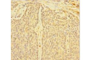 Immunohistochemistry of paraffin-embedded human ovarian cancer using ABIN7149718 at dilution of 1:100 (DNTTIP1 anticorps  (AA 1-329))