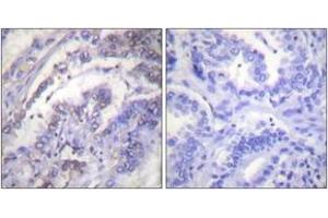 Immunohistochemistry analysis of paraffin-embedded human lung carcinoma tissue, using Histone H3 (Ab-3) Antibody. (Histone 3 anticorps  (AA 1-50))