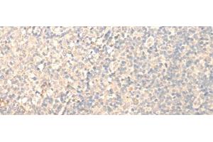 Immunohistochemistry of paraffin-embedded Human tonsil tissue using MRPL1 Polyclonal Antibody at dilution of 1:25(x200)
