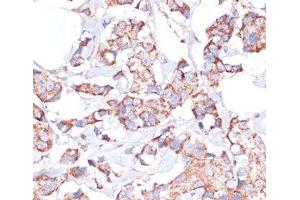 Immunohistochemistry of paraffin-embedded Human breast cancer using UBE2O Polyclonal Antibody at dilution of 1:100 (40x lens). (UBE2O anticorps)