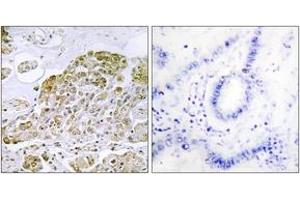 Immunohistochemistry analysis of paraffin-embedded human lung carcinoma tissue, using TFEB Antibody. (TFEB anticorps  (AA 10-59))