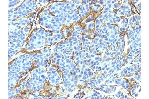 Formalin-fixed, paraffin-embedded human Melanoma stained with NGFR Monoclonal Antibody (NTR/912). (NGFR anticorps)