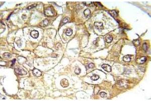 Immunohistochemistry (IHC) analyzes of p-ERK1/2 antibody in paraffin-embedded human breast carcinoma tissue. (ERK1 anticorps  (pThr202, pTyr204))