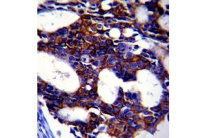 Paraformaldehyde-fixed, paraffin embedded human breast carcinoma, Antigen retrieval by boiling in sodium citrate buffer (pH6.